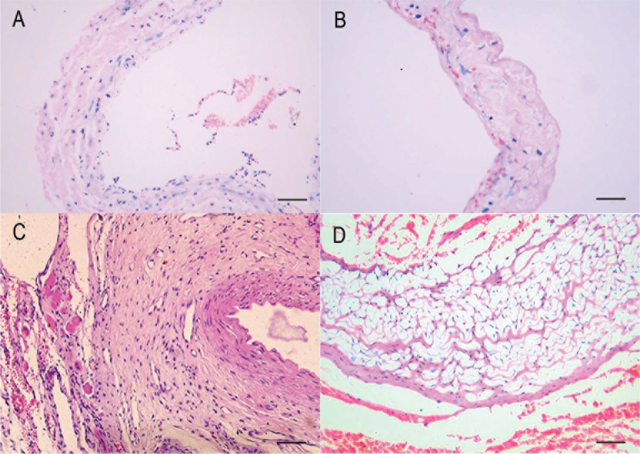 Hydraulic expansion facilitates remodeling of arteriovenous fistulas without increasing venous intimal hyperplasia in rabbits.