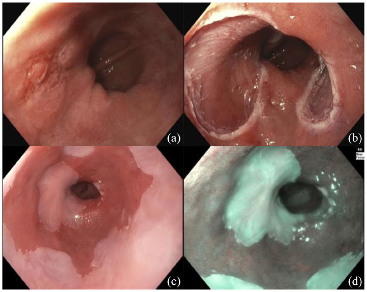 The evolution of endoscopic therapy for Barrett's esophagus.