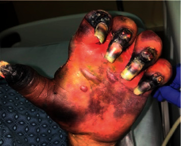 A Devastating Case of Hepatitis C-Induced Mixed Cryoglobulinemia.