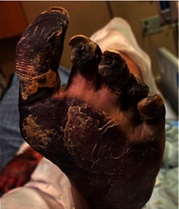 A Devastating Case of Hepatitis C-Induced Mixed Cryoglobulinemia.