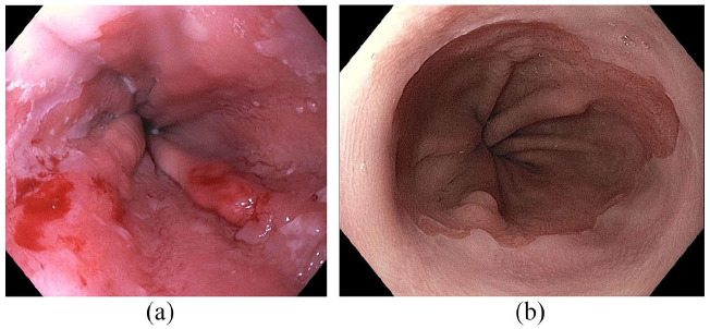 The evolution of endoscopic therapy for Barrett's esophagus.