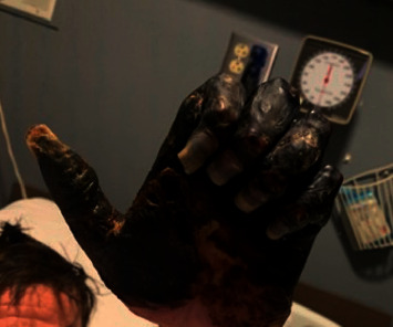 A Devastating Case of Hepatitis C-Induced Mixed Cryoglobulinemia.