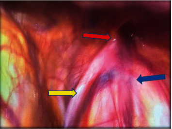 Right Transverse Testicular Ectopia: A Nonclassified Variant Confirmed on Laparoscopy.