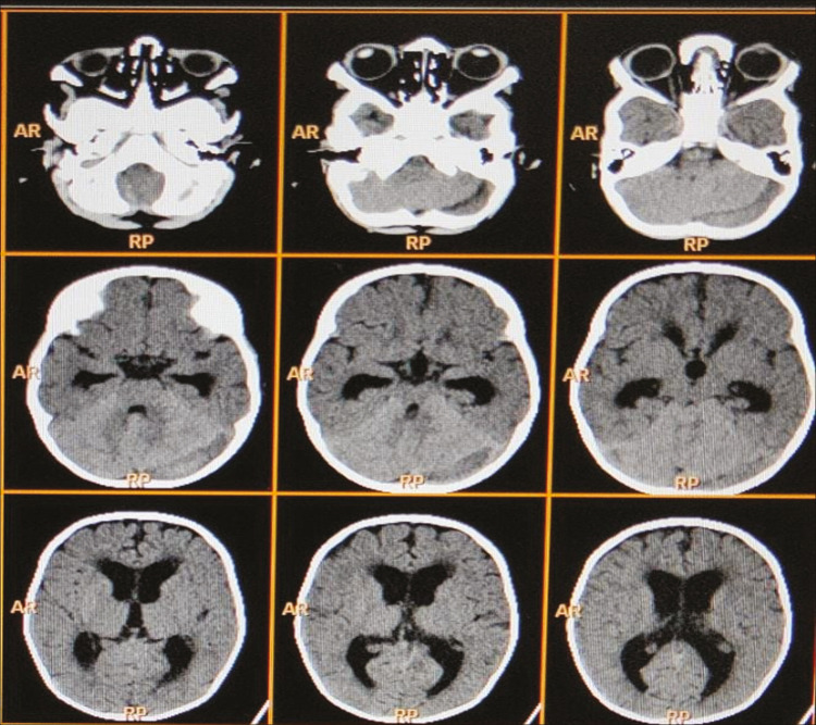 Posterior Fossa Hematoma Following Minor Trauma in an Infant with Rare Combined Factor V and Factor X Deficiency.