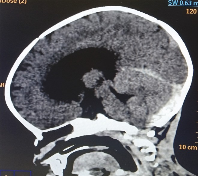 Posterior Fossa Hematoma Following Minor Trauma in an Infant with Rare Combined Factor V and Factor X Deficiency.