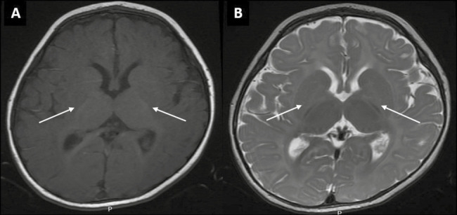 Thyroid Hormone Transporter Defect: Allan Herndon Dudley Syndrome, Masquerading as Dyskinetic Cerebral Palsy.