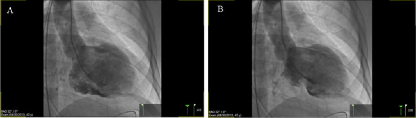 Anomalous origin of the left main from the right coronary sinus presenting with sudden cardiac death: utility of mechanical circulatory support.