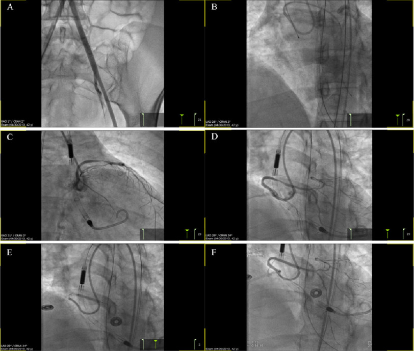 Anomalous origin of the left main from the right coronary sinus presenting with sudden cardiac death: utility of mechanical circulatory support.