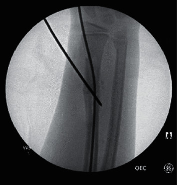 Operative Fixation of Pediatric Forearm Fractures: Does the Fracture Location Matter?