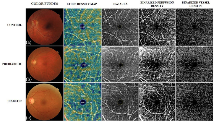 Early microvascular changes in patients with prediabetes evaluated by optical coherence tomography angiography.