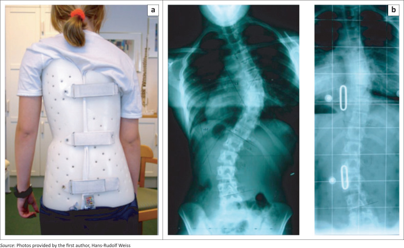 Brace treatment for patients with scoliosis: State of the art.