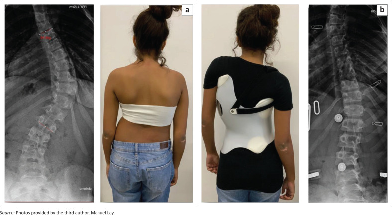 Brace treatment for patients with scoliosis: State of the art.