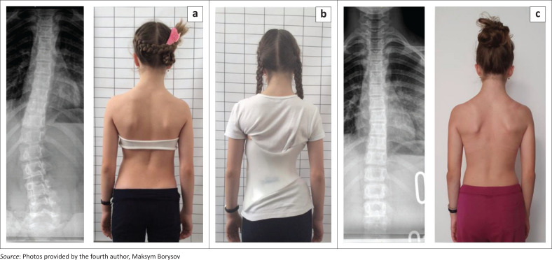 Brace treatment for patients with scoliosis: State of the art.