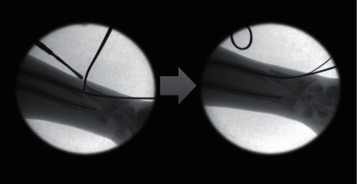 Operative Fixation of Pediatric Forearm Fractures: Does the Fracture Location Matter?