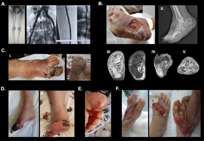 Risk factors for diabetic foot ulcers in metreleptin naïve patients with lipodystrophy.