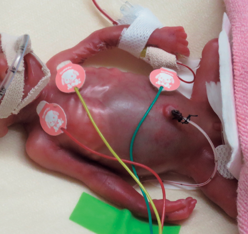 Respiratory and Gastrointestinal Management of an Infant with a Birth Weight of 258 Grams.