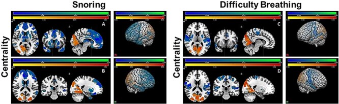 Shorter Duration and Lower Quality Sleep Have Widespread Detrimental Effects on Developing Functional Brain Networks in Early Adolescence.