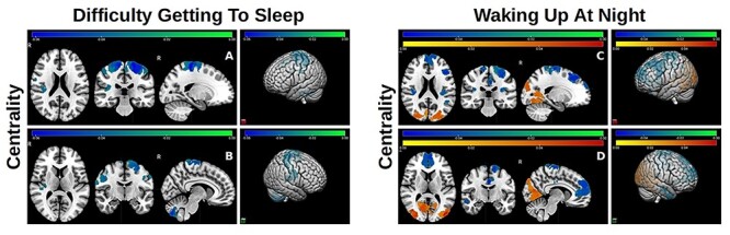 Shorter Duration and Lower Quality Sleep Have Widespread Detrimental Effects on Developing Functional Brain Networks in Early Adolescence.