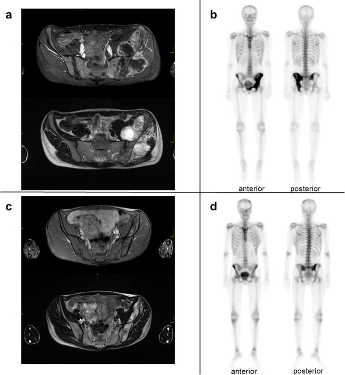 Unusual course of disease and genetic profile in Li-Fraumeni syndrome-associated osteosarcoma - a case report.