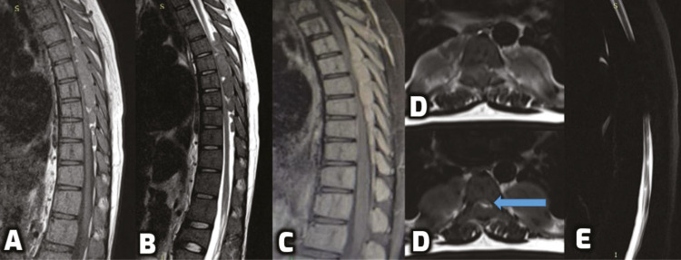 Extramedullary Hematopoiesis Presenting with Thoracic Spinal Cord Compression in a Young Adult with Thalassemia Major: A Case Report.