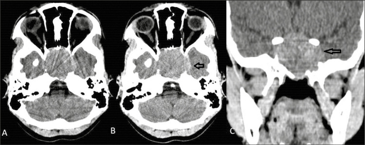 Intrasphenoidal Rathke Cleft Cyst: A Rare Case Report.