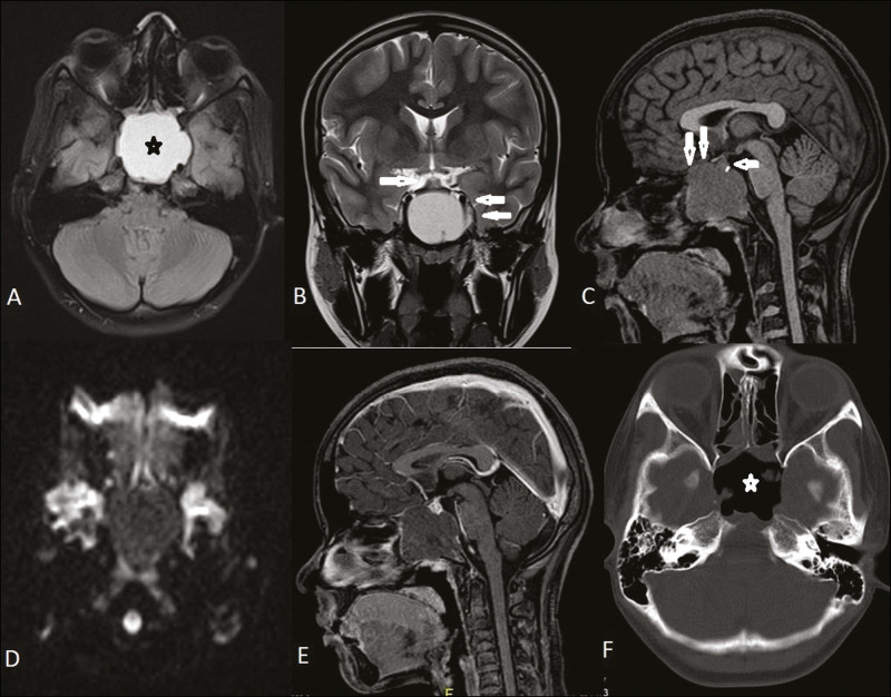 Intrasphenoidal Rathke Cleft Cyst: A Rare Case Report.