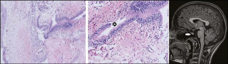 Intrasphenoidal Rathke Cleft Cyst: A Rare Case Report.