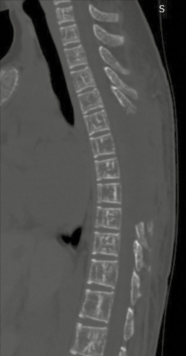 Extramedullary Hematopoiesis Presenting with Thoracic Spinal Cord Compression in a Young Adult with Thalassemia Major: A Case Report.