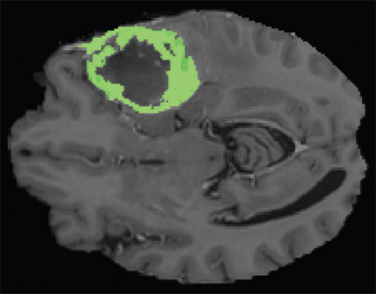 Brain Tumor Segmentation Using Graph Coloring Approach in Magnetic Resonance Images.