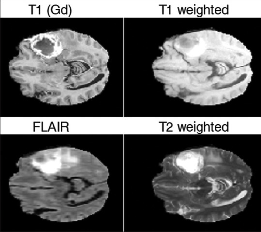 Brain Tumor Segmentation Using Graph Coloring Approach in Magnetic Resonance Images.