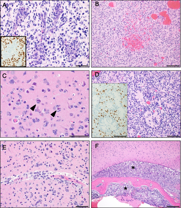 Genome editing of <i>Nf1, Pten,</i> and <i>Trp53</i> in neonatal mice induces glioblastomas positive for oligodendrocyte lineage transcription factor 2.