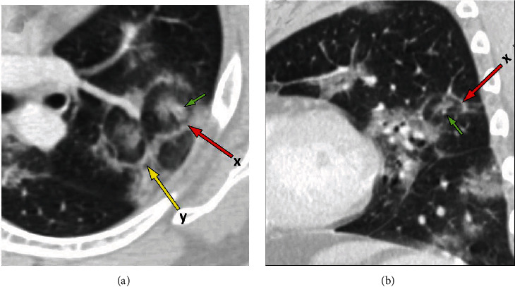 The "Target Sign" in a 46-Year-Old Patient with COVID-19 Pneumonia.