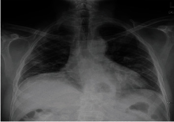 The "Target Sign" in a 46-Year-Old Patient with COVID-19 Pneumonia.