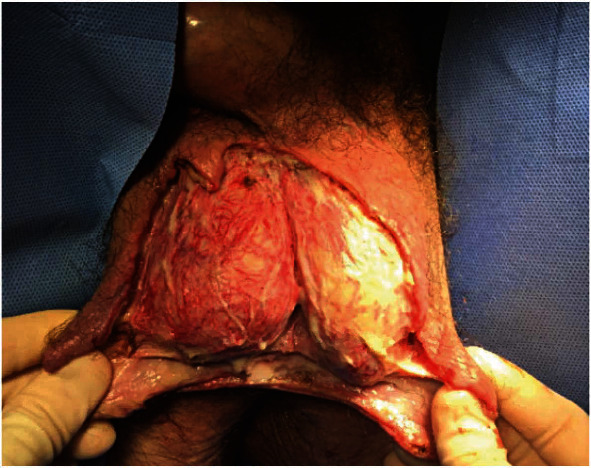 New Methods of Reconstruction for Old Challenges: The Use of the Integra Graft in Necrotizing Soft Tissue Infections of the Male Genitalia.