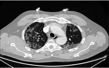 The "Target Sign" in a 46-Year-Old Patient with COVID-19 Pneumonia.