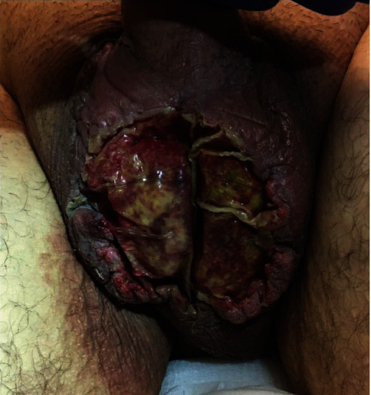 New Methods of Reconstruction for Old Challenges: The Use of the Integra Graft in Necrotizing Soft Tissue Infections of the Male Genitalia.