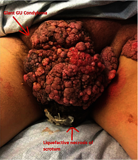 New Methods of Reconstruction for Old Challenges: The Use of the Integra Graft in Necrotizing Soft Tissue Infections of the Male Genitalia.