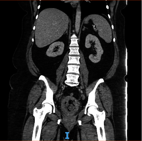 Medical Management of Pyometra in the Delayed Postoperative Period.