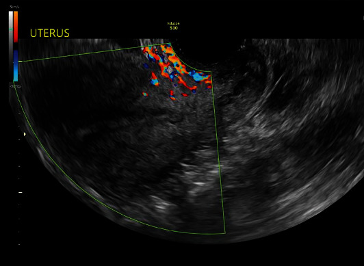 Medical Management of Pyometra in the Delayed Postoperative Period.