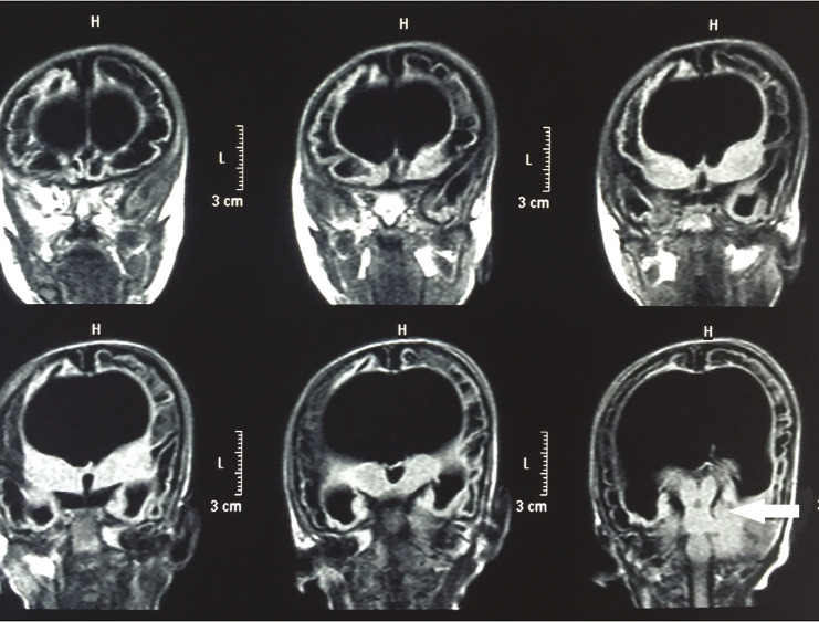 Development Delay in a Child with Microcephaly and Birth Asphyxia: Explore Diagnosis beyond Hypotonic Cerebral Palsy.