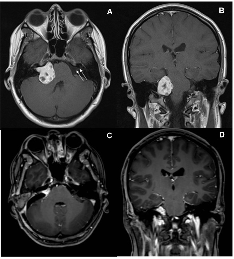 Neuro-Ophthalmic Complications of Vestibular Schwannoma Resection: Current Perspectives.