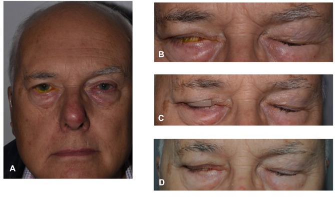 Neuro-Ophthalmic Complications of Vestibular Schwannoma Resection: Current Perspectives.