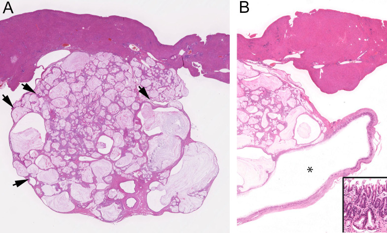 Spontaneous cholangiofibrosis adjacent to a dilated common bile duct with intestinal metaplasia in a Royal College of Surgeons rat.