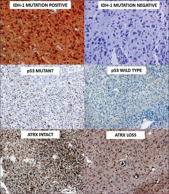 Molecular classification and stratification of adult diffuse gliomas: A tertiary care center study.