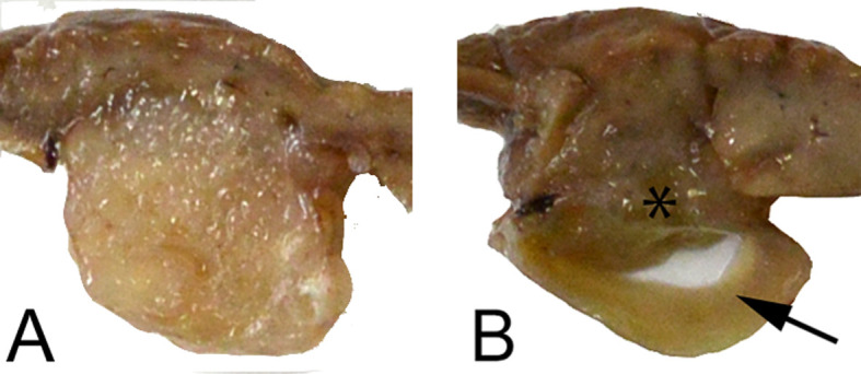 Spontaneous cholangiofibrosis adjacent to a dilated common bile duct with intestinal metaplasia in a Royal College of Surgeons rat.