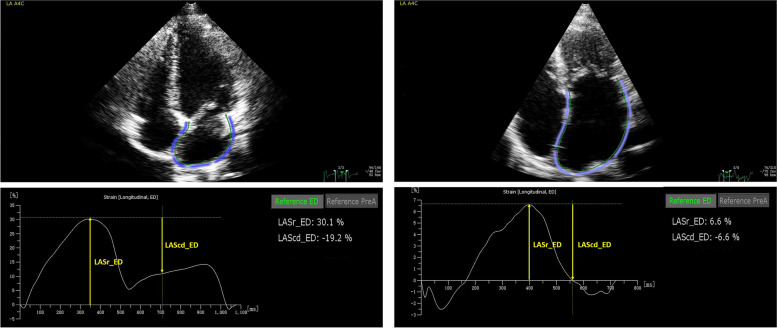 The role of left atrial strain in patients with functional tricuspid regurgitation before and after annuloplasty: a long-term follow-up study.