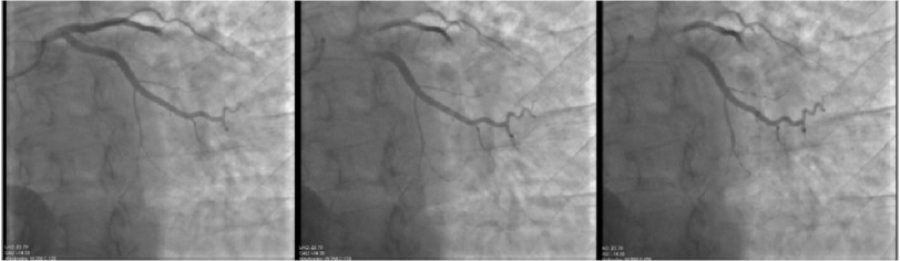 A case of coronary artery air embolism in a transplanted heart during cardiac allograft vasculopathy surveillance angiography.