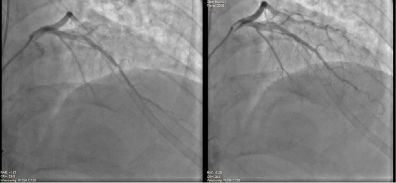 A case of coronary artery air embolism in a transplanted heart during cardiac allograft vasculopathy surveillance angiography.