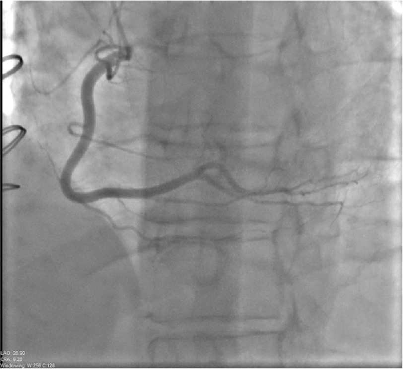 A case of coronary artery air embolism in a transplanted heart during cardiac allograft vasculopathy surveillance angiography.