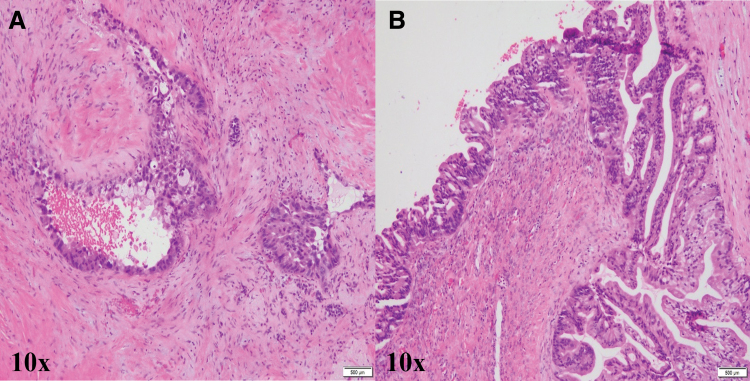 Isolated Ovarian Metastasis from Pancreatic Cancer Mimicking Primary Ovarian Neoplasia: Role of Molecular Analysis in Determining Diagnosis.